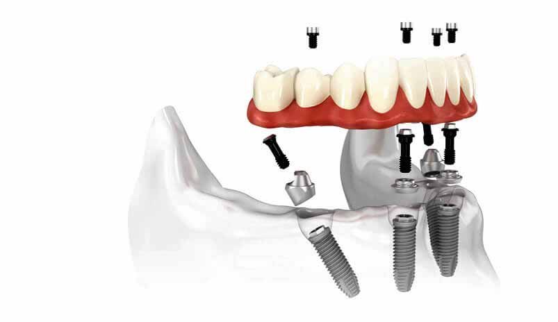 Image result for چند عامل مهم بر موفقیت ایمپلنت دندان"